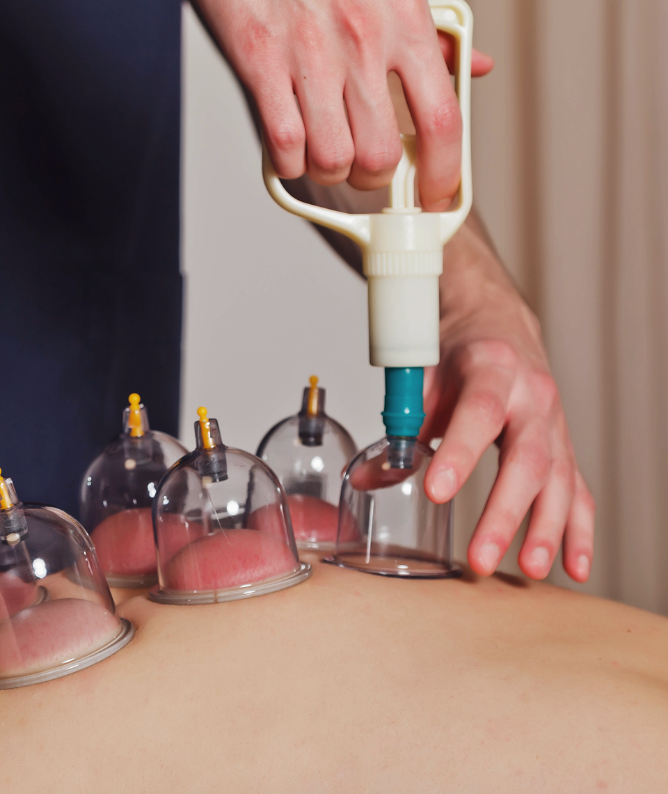 Dry Cupping Therapy